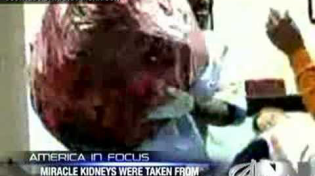 Thumbnail for Anonymous Hero Donates Hospital 200 Human Kidneys | The Onion